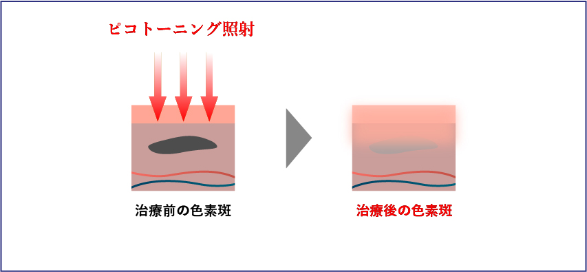 ピコトーニングの治療画像